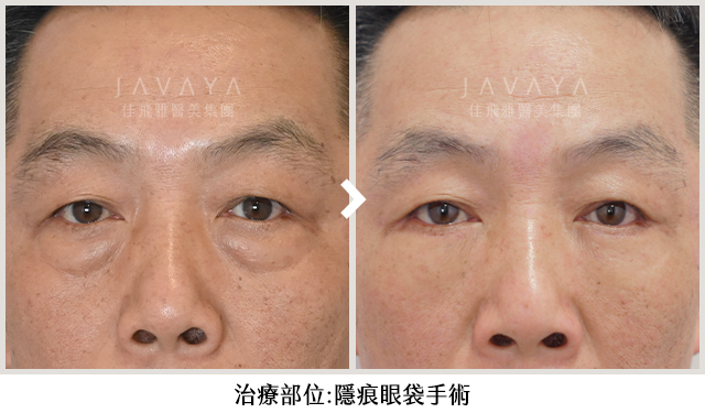 Before|看起來疲憊沒睡飽。 After|看起來年輕有精神多了